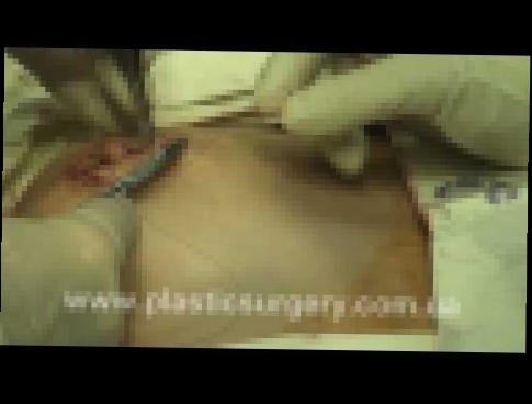 Уменьшение ареолы с коррекцией соска | Areola reduction | Live Surgery 
