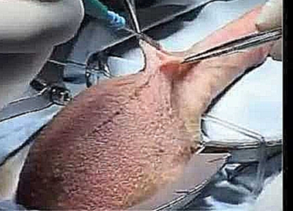 Операция по установке пенильного протеза TUBE производства Promedon Аргентина 
